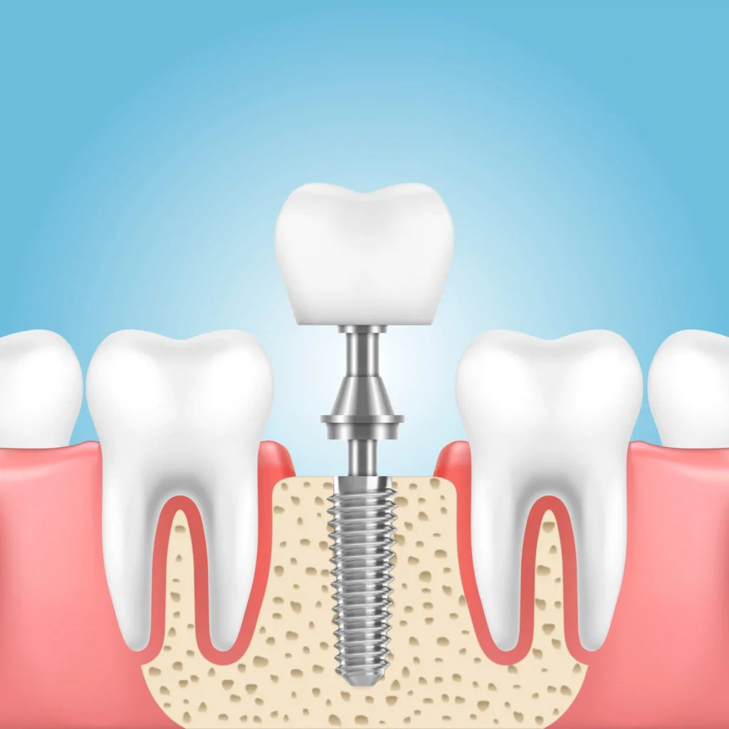 Best Dental Implants in Hinjewadi| Dental Hub Baner Pune Hinjewadi